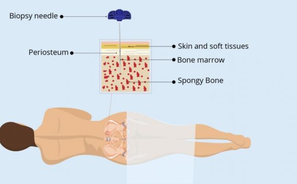 Bone Marrow Evaluation